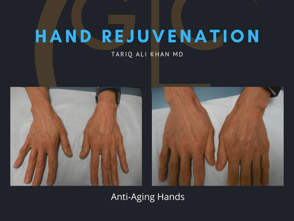 Gentle Care Laser Tustin Before and After picture - Hand Rejuvenation